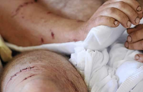 Before his release Tuesday from Millinocket Regional Hospital, Ryan Shepard, a registered guide from T5R7, showed the Bangor Daily News the bite injuries he sustained to his arms and legs when a bear attacked him while he was hunting off the Shin Pond Road hunting Monday morning, September 13, 2010. (Bangor Daily News/John Clarke Russ) Before his release Tuesday from Millinocket Regional Hospital, Ryan Shepard, a registered guide from T5R7, showed the Bangor Daily News the bite injuries he sustained to his arms and legs when a bear attacked him while he was hunting off the Shin Pond Road hunting Monday morning, September 13, 2010. (Bangor Daily News/John Clarke Russ)
