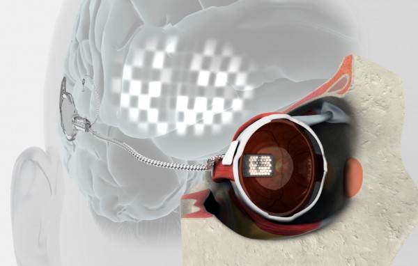 An early bionic eye prototype drawing. An early bionic eye prototype drawing.
